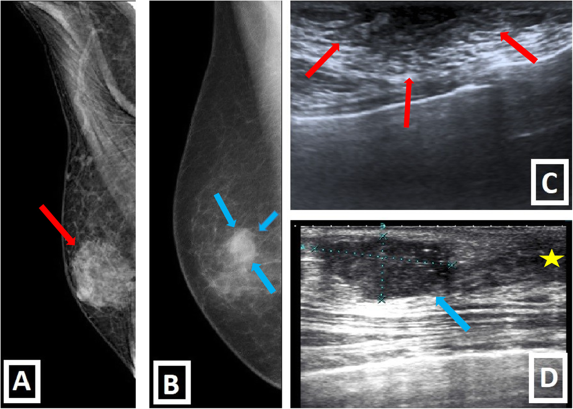 Breast mammogram showed bilateral benign gynecomastia, with the