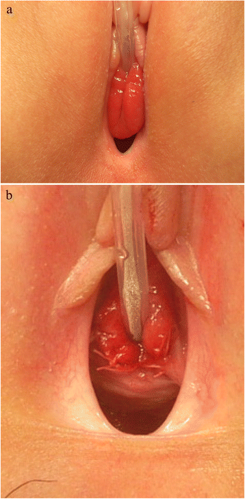 Urethral caruncle a girl: a case report and review of the literature | Journal of Medical Case Reports | Full Text