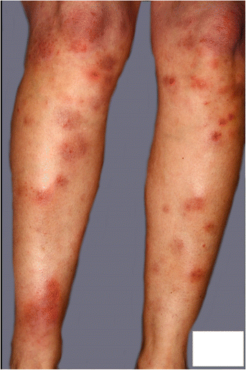 Figure 1 | Erythema nodosum as a result of estrogen patch therapy for  prostate cancer: a case report | SpringerLink