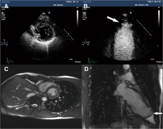Coexistence of congenital left ventricular aneurysm and prominent left ventricular trabeculation ...
