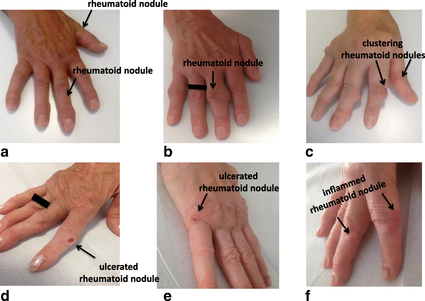 nodulos+subcutaneos+artritis+reumatoide
