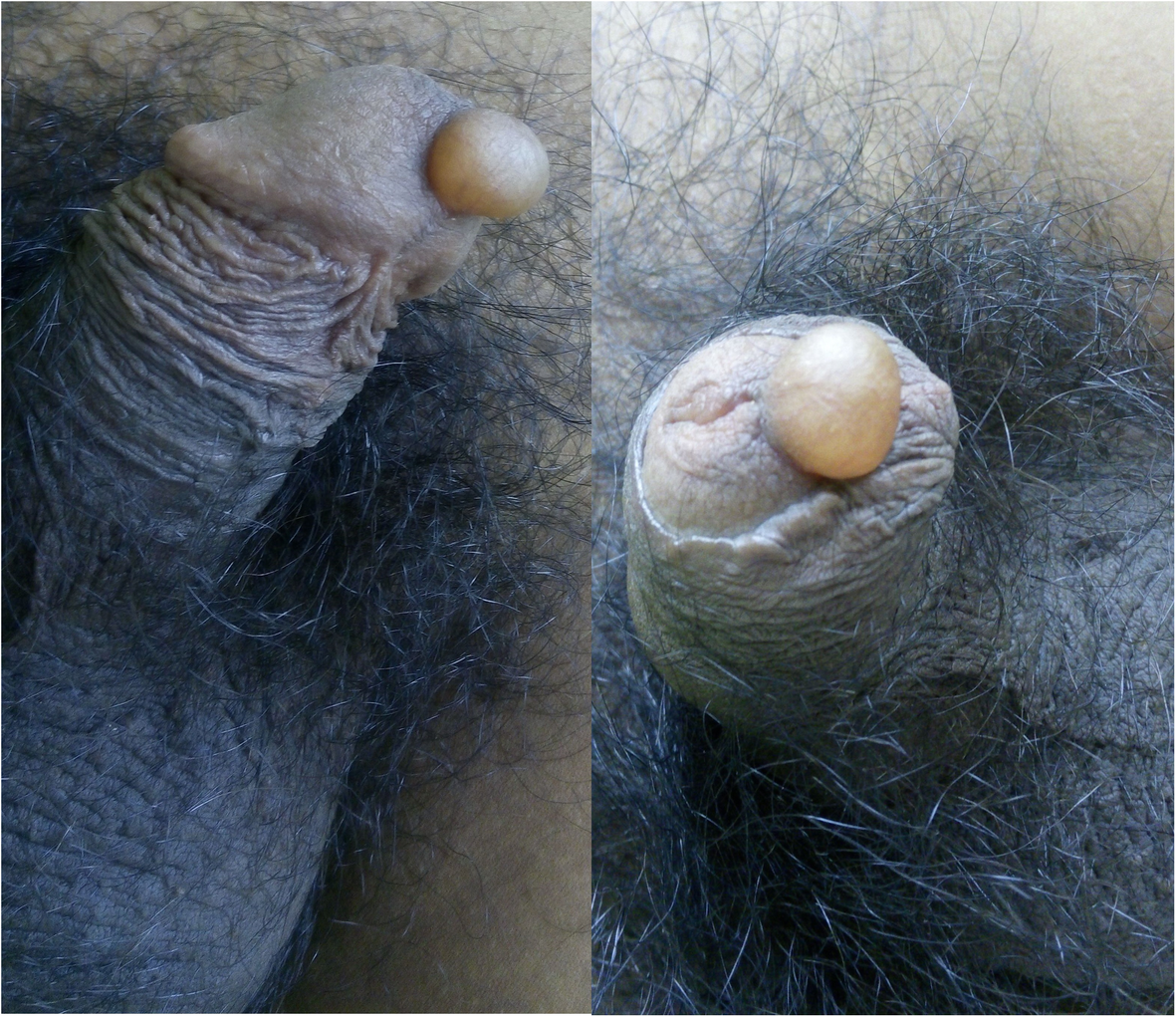Median raphe cyst of the penis: a case report and review of the literature  | Journal of Medical Case Reports | Full Text