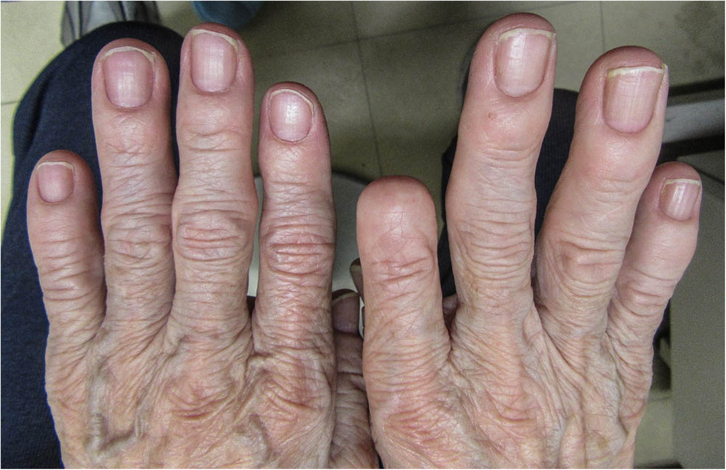 Yellow nail syndrome following multiple orthopedic surgeries a case