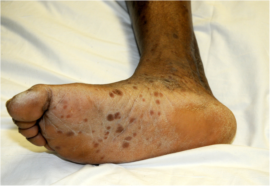 diffuse erythematous rash