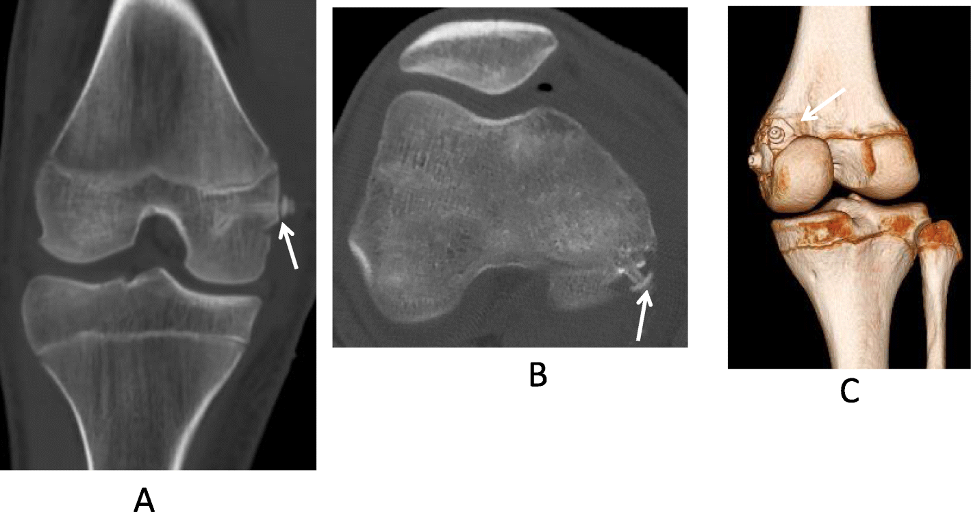 Avulsion fracture of the medial head of the gastrocnemius muscle associated  with multiple ligament injuries before closure of the growth plate: a case  report | Journal of Medical Case Reports | Full Text