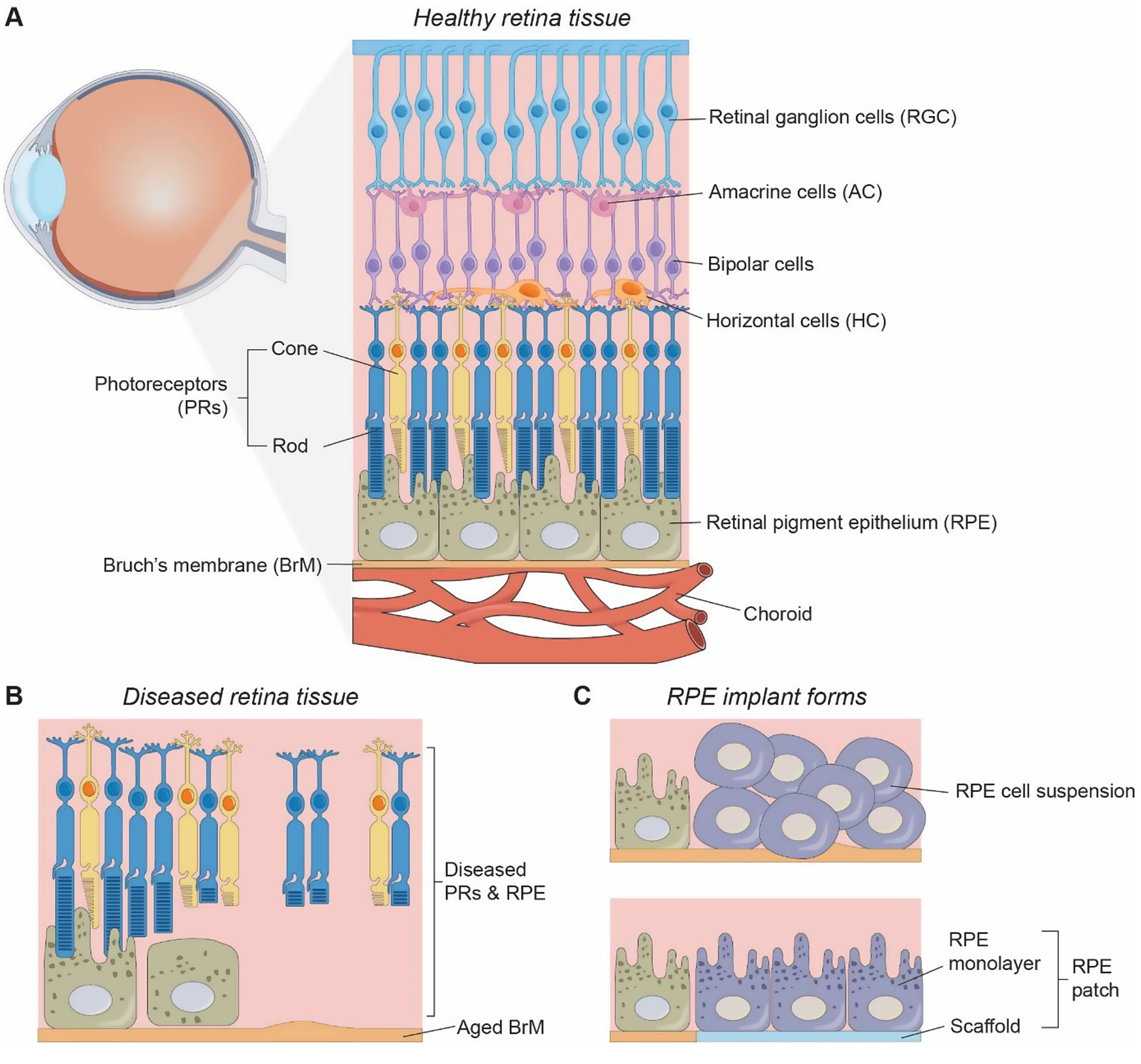 Schematic illustration of (A) the tissue structure of the human retina, (B) diseased PR and RPE cells, and (C) two forms of RPE cell therapy: cell suspension-based and RPE cell patch-based