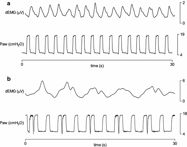 Transcutaneous electromyographic respiratory muscle recordings to quantify  patient–ventilator interaction in mechanically ventilated children | Annals  of Intensive Care | Full Text