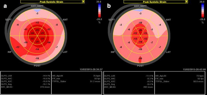 Longitudinal strain bull's eye plot patterns in patients with  cardiomyopathy and concentric left ventricular hypertrophy, European  Journal of Medical Research