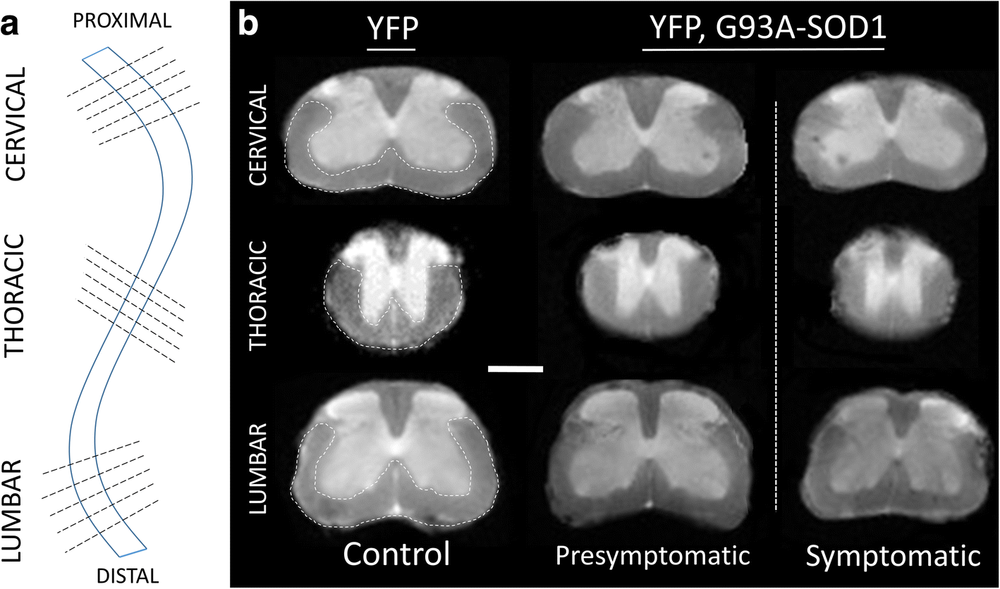 Ultra-High Field Diffusion MRI Reveals Early Axonal Pathology in Spinal Cord  of ALS mice | Translational Neurodegeneration | Full Text