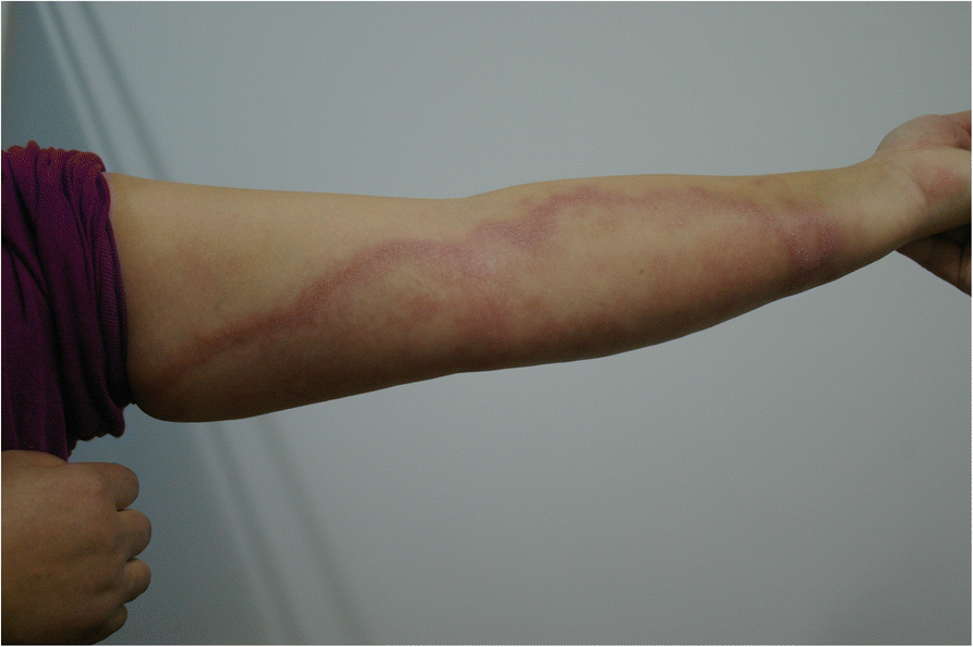 A rare case of type 1 leprosy reactions following tetanus infection in