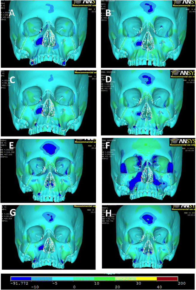 The efficacy of maxillary protraction protocols with the  micro-implant-assisted rapid palatal expander (MARPE) and the novel N2  mini-implant—a finite element study | Progress in Orthodontics | Full Text