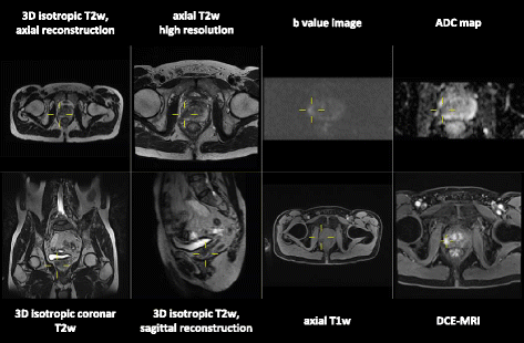 prostate mri