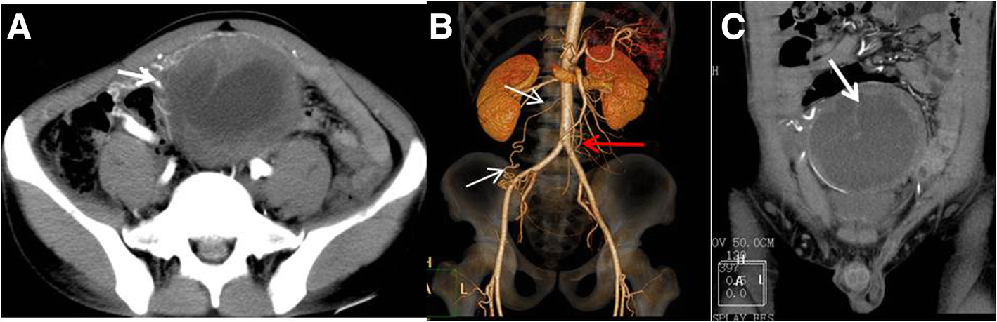 Diagnostic value of multislice spiral computed tomography (CT) combined  with CT angiography for intra-abdominal undescended testis secondary  seminomas | Cancer Imaging | Full Text
