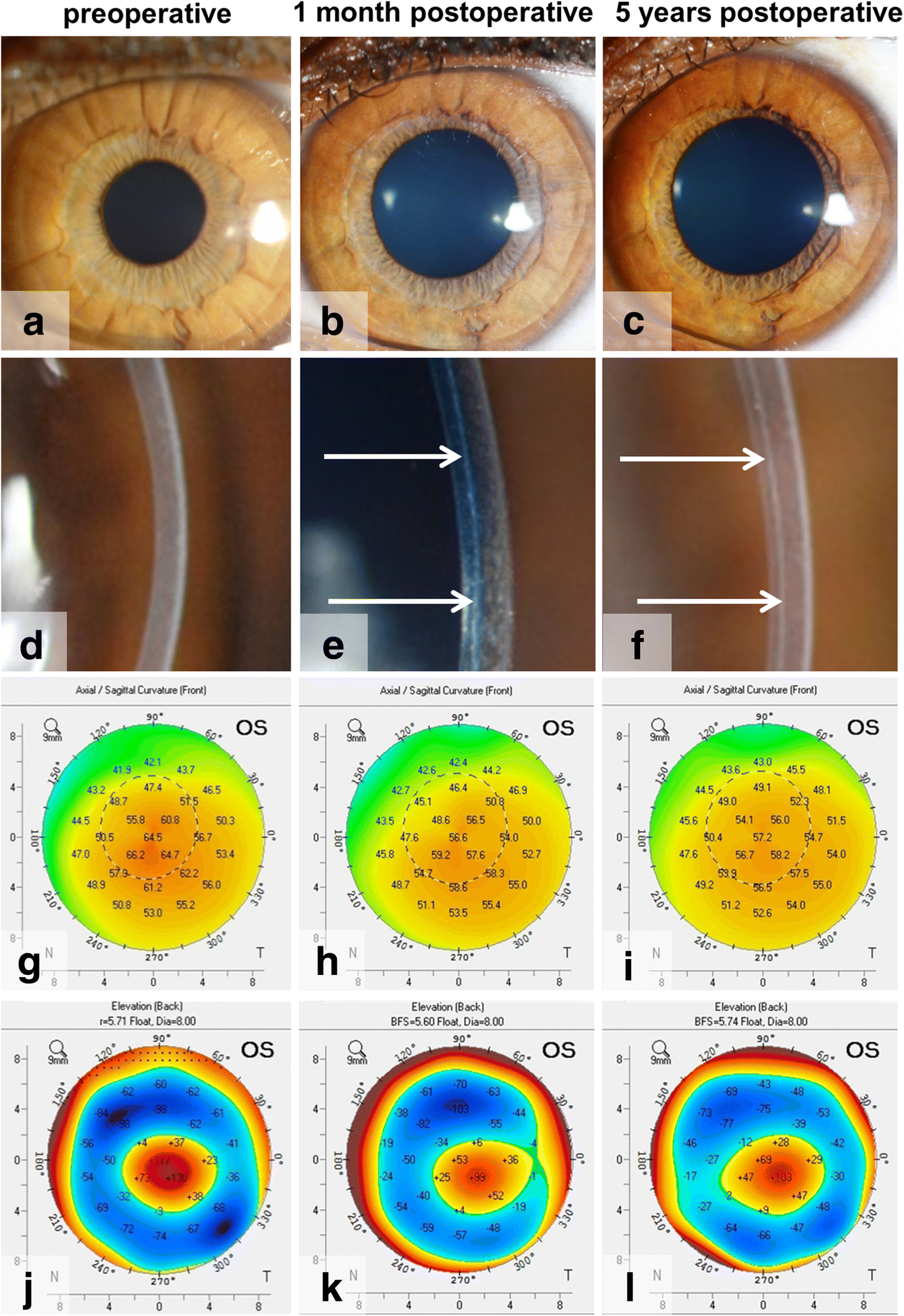 Bowman layer transplantation in the treatment of keratoconus | Eye and  Vision | Full Text