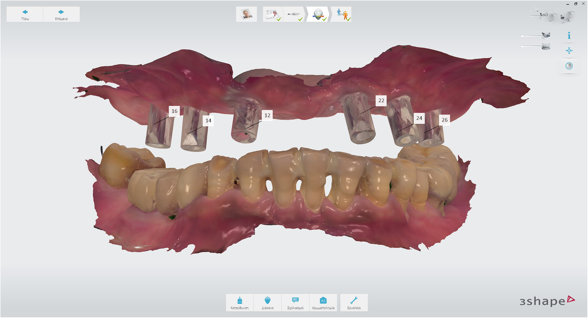 Using the surgical guide for impressionfree digital bite registration