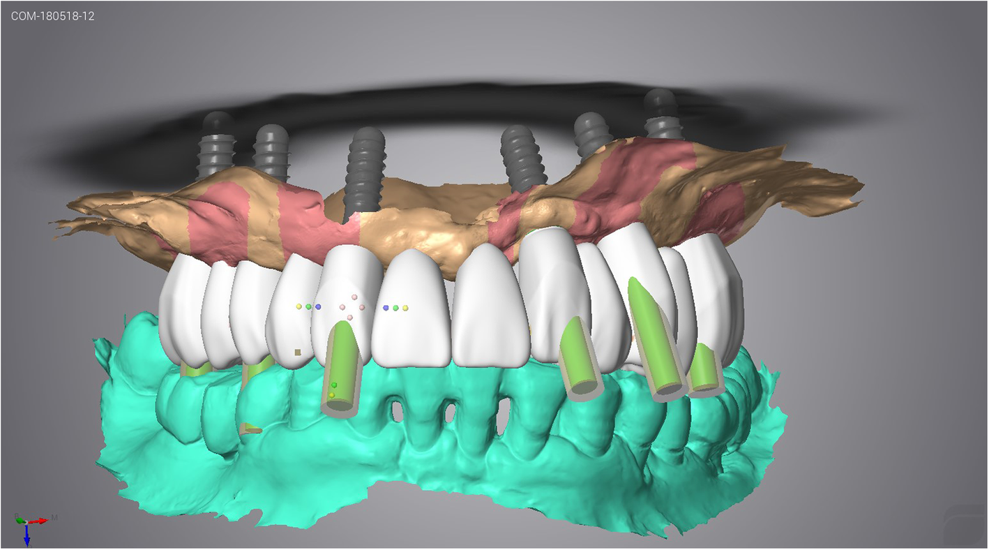 Using the surgical guide for impressionfree digital bite registration