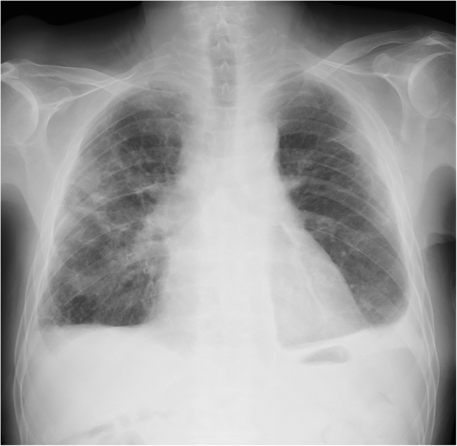 Intractable pneumothorax due to rupture of subpleural rheumatoid ...