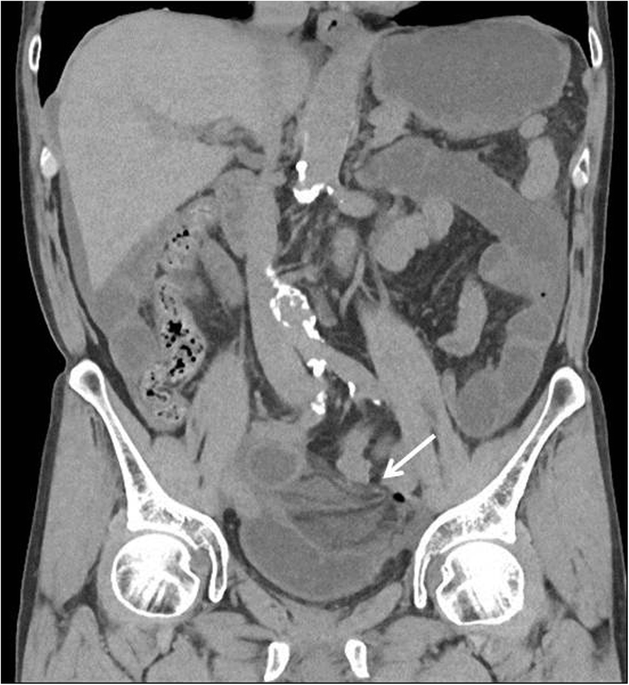 Internal Hernia Beneath The Left External Iliac Artery After Robotic Assisted Laparoscopic