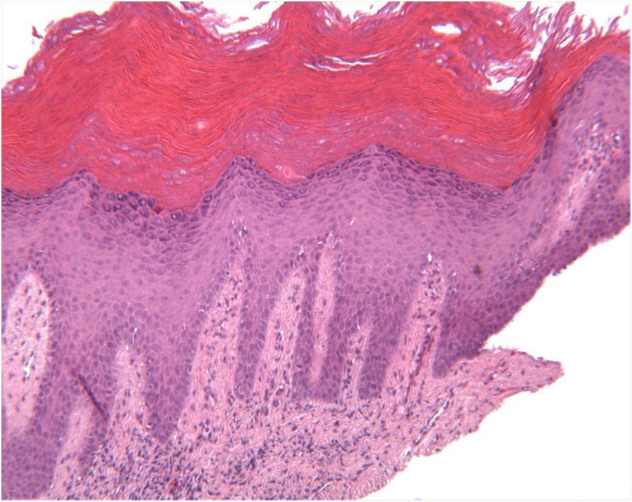 Гиперкератоз гистология. Гиперкератоз кожи гистология. Лейкоплакия гистология. Лейкоплакия патанатомия.