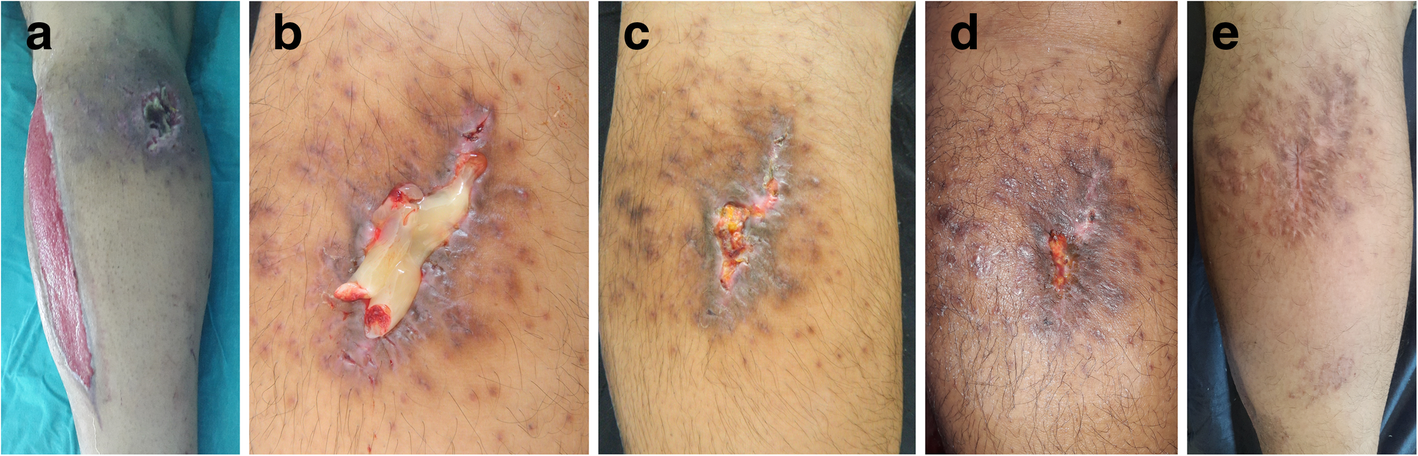 Leucocyte- and platelet-rich fibrin as a rescue therapy for  small-to-medium-sized complex wounds of the lower extremities | Burns &  Trauma | Full Text