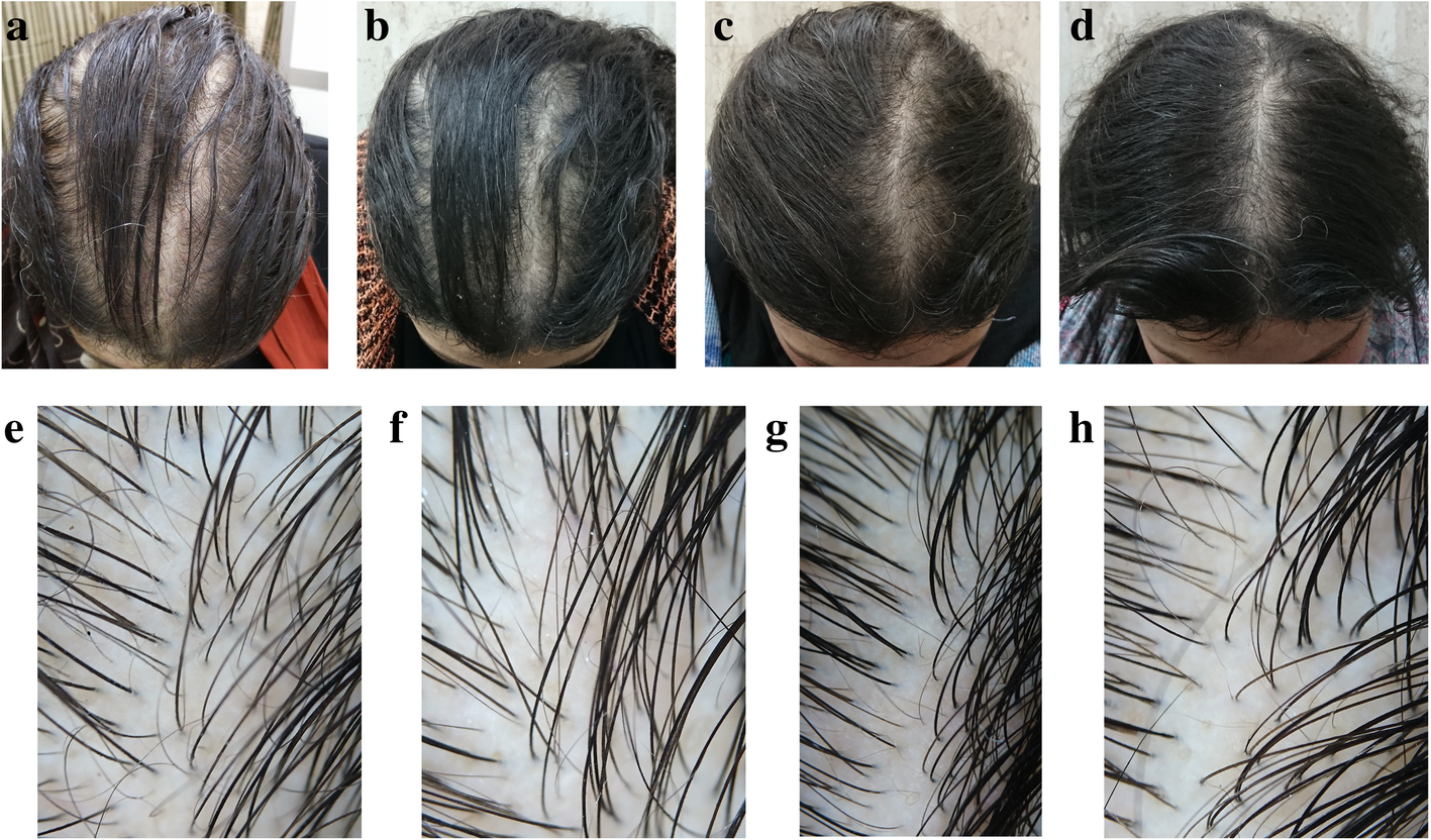 Encommium bjælke hvis du kan Trichogenic effect of topical ketoconazole versus minoxidil 2% in female  pattern hair loss: a clinical and trichoscopic evaluation | Biomedical  Dermatology | Full Text