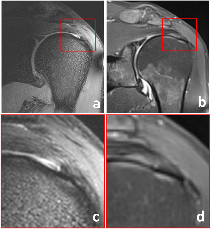 7-T clinical MRI of the shoulder in patients with suspected lesions of the rotator  cuff | European Radiology Experimental | Full Text