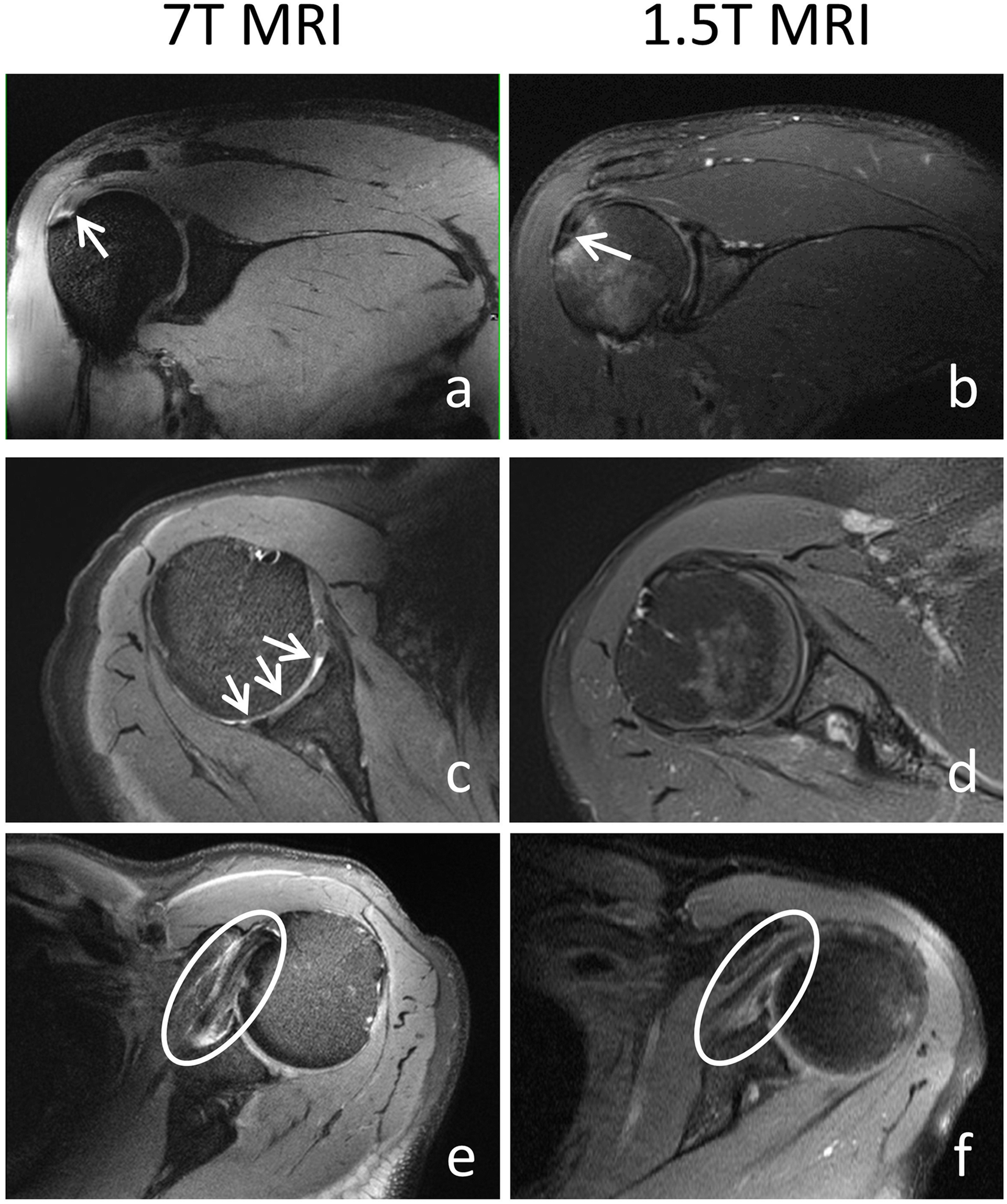 7-T clinical MRI of the shoulder in patients with suspected lesions of the rotator  cuff | European Radiology Experimental | Full Text