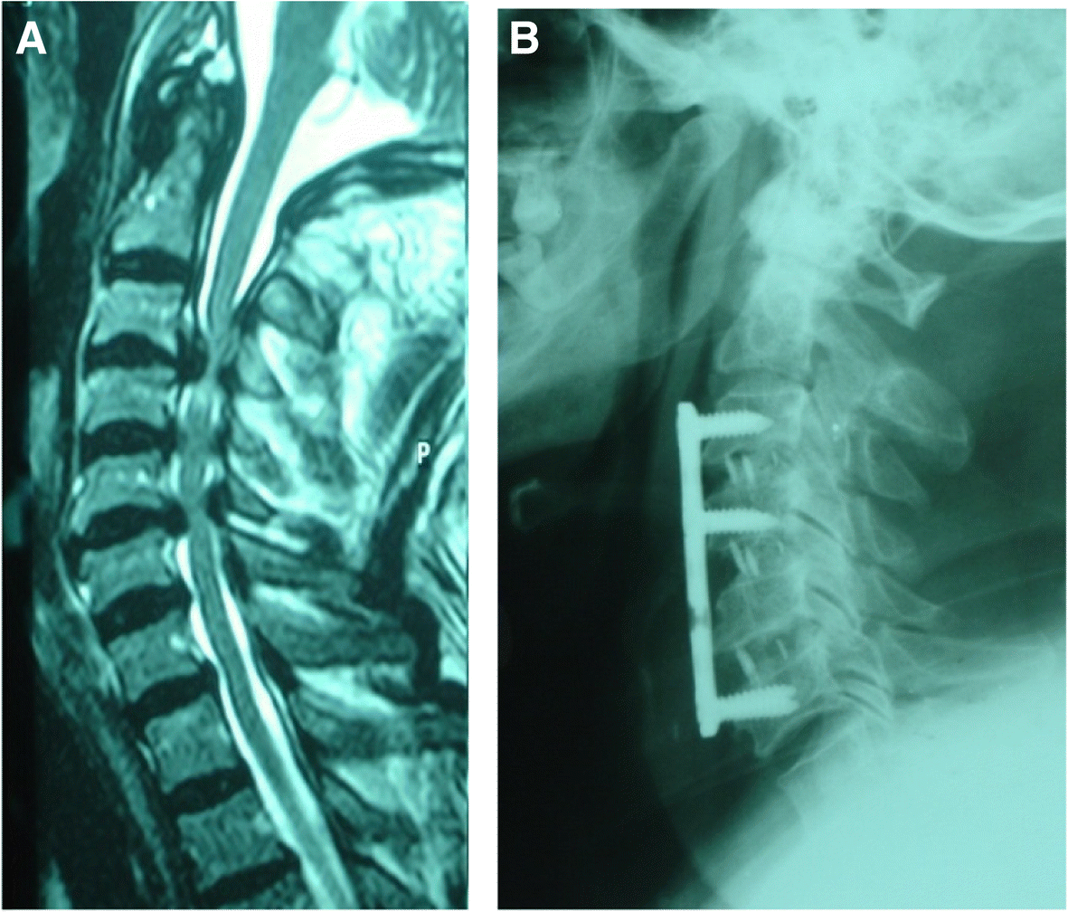Fixation of multiple level anterior cervical disc using cages versus cages  and plating | The Egyptian Journal of Neurology, Psychiatry and  Neurosurgery | Full Text