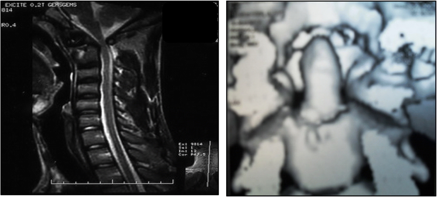 type 3 odontoid fracture type 3 odontoid fracture