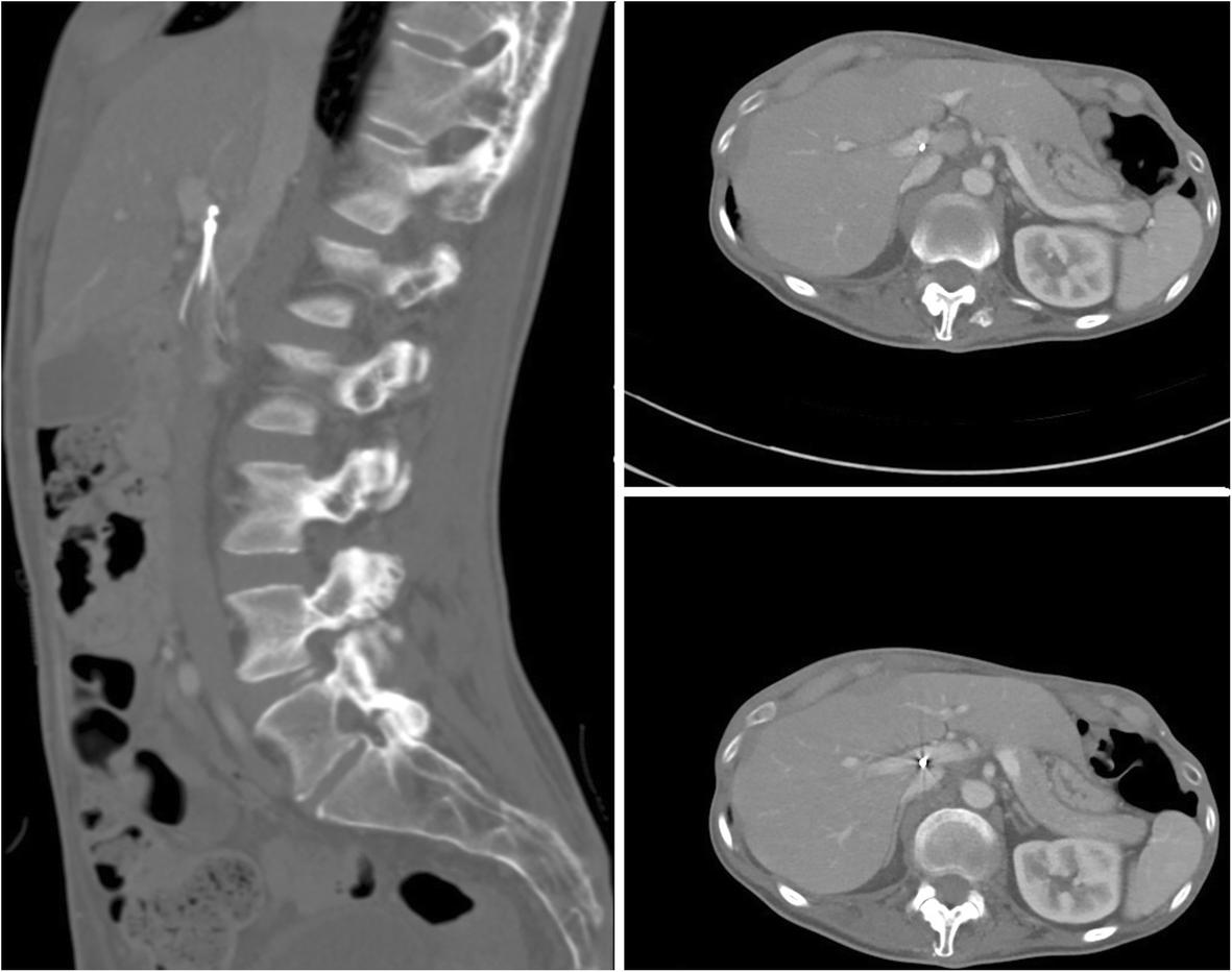 Procedural complications of inferior vena cava filter retrieval, an  illustrated review | CVIR Endovascular | Full Text