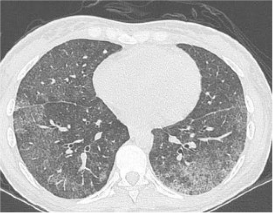 Fig. 1 (abstract P451).