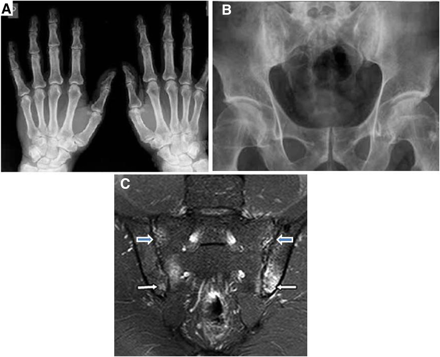 Frequency of inflammatory back pain sacroiliitis in patients with rheumatoid | Egyptian Journal of Radiology and Nuclear Medicine | Full Text