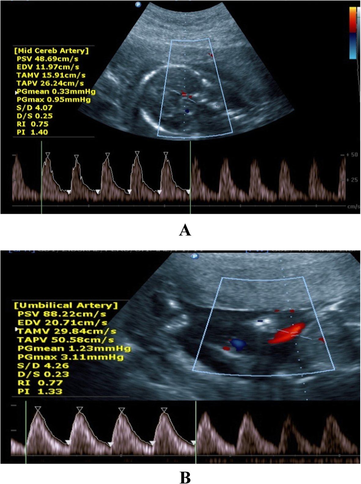 Ultrasound angiology reference standards of fetal cerebroplacental flow in  normal Egyptian gestation: statistical analysis of one thousand  observations | Egyptian Journal of Radiology and Nuclear Medicine | Full  Text