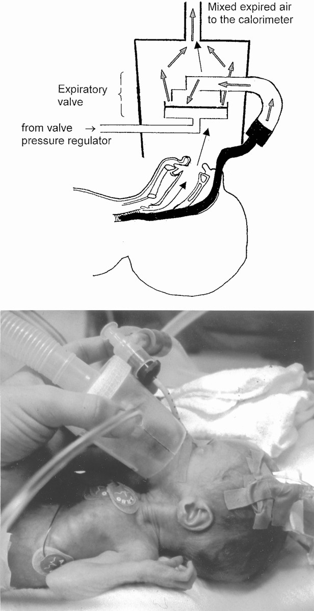 In Vitro Validation and Clinical Testing of an Indirect Calorimetry System  for Ventilated Preterm Infants That Is Unaffected by Endotracheal Tube  Leaks and Can Be Used during Nasal Continuous Positive Airway Pressure