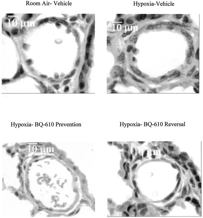 Endothelin A Receptor Blockade Prevents And Partially