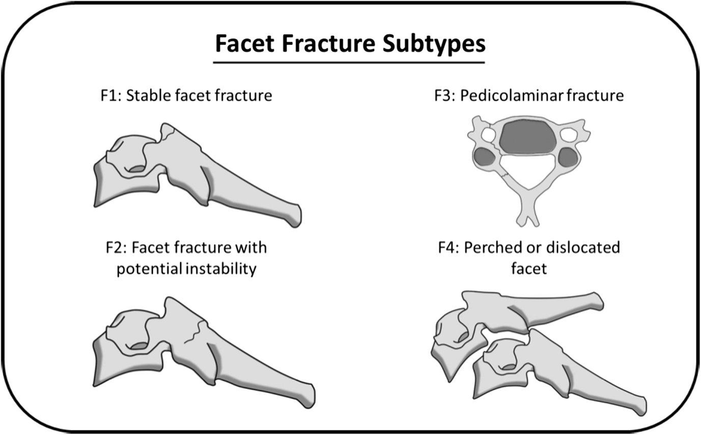 There has to be an easier way facet fracture characteristics that