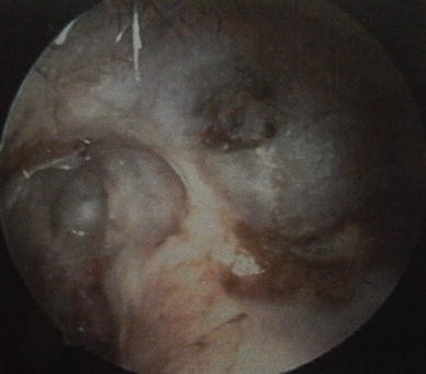 mastoid obliteration mastoid obliteration