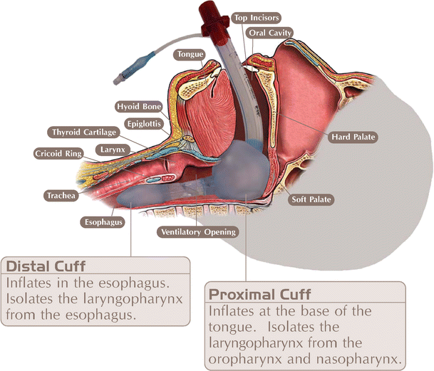 A pilot study of the King LT supralaryngeal airway use in a rural Iowa