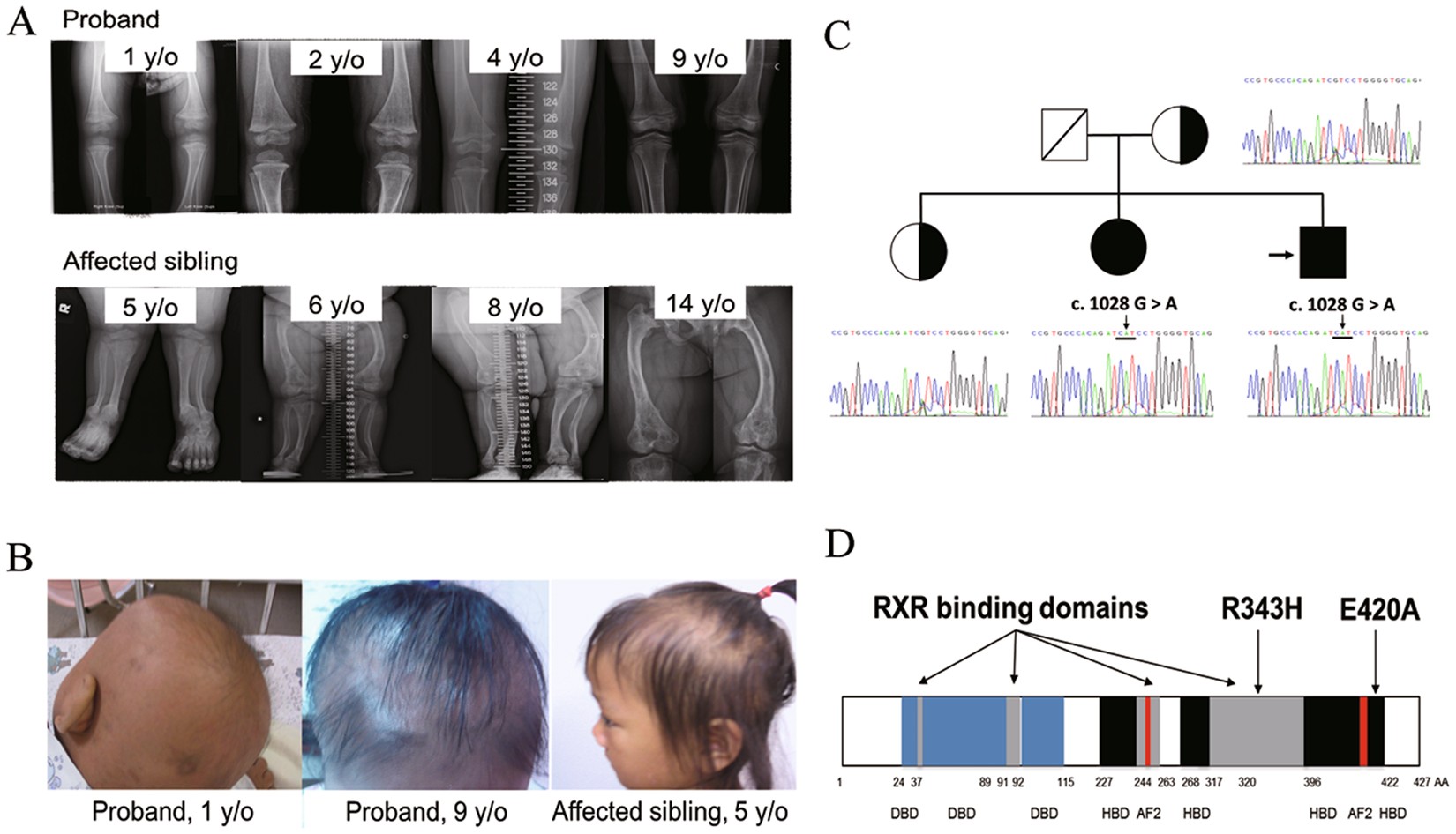 Vitamin D Resistant Rickets Type 2