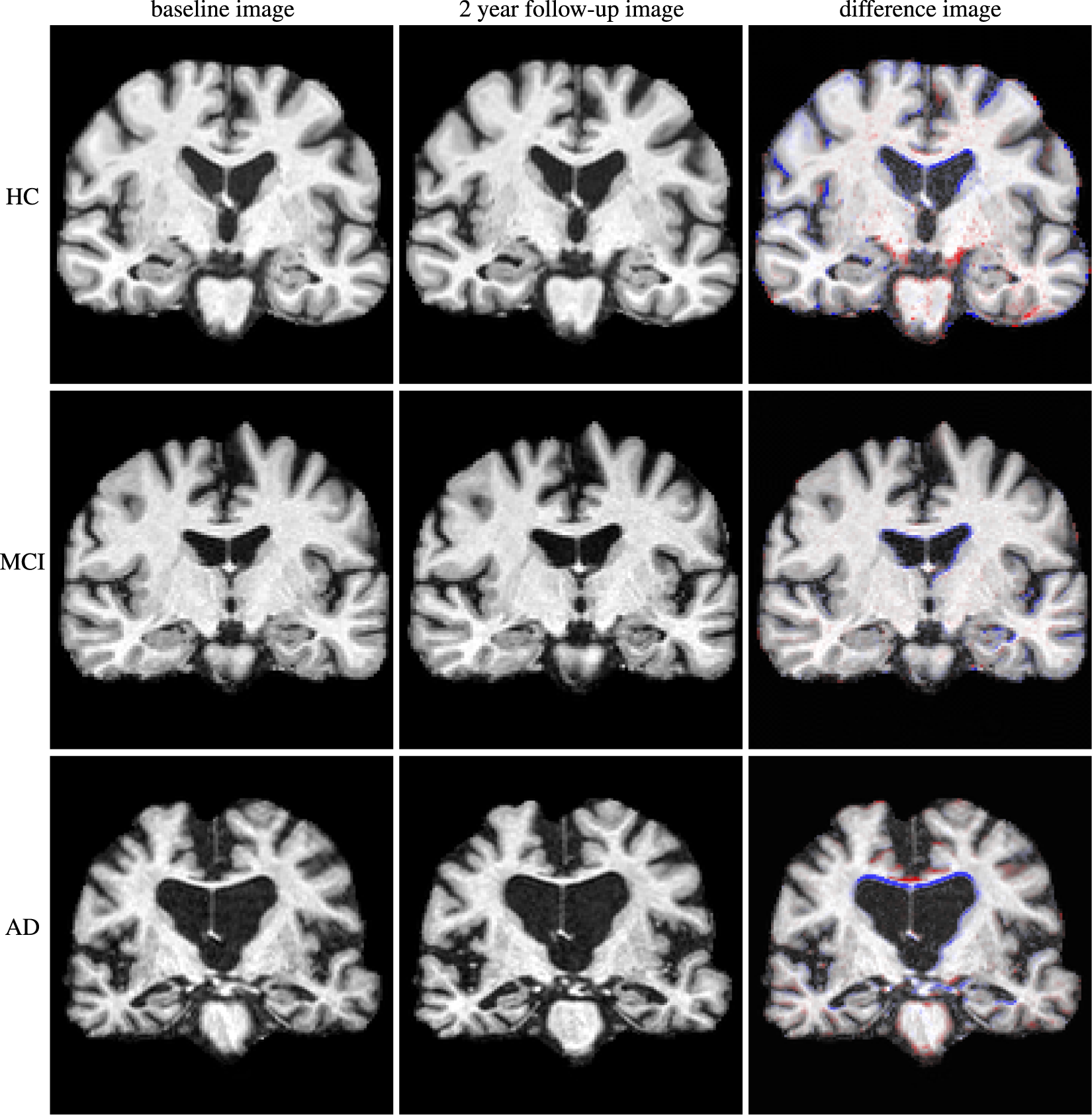Machine Learning Framework For Early Mri Based Alzheimers ...