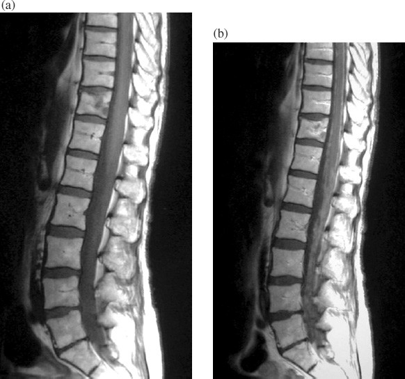 Spinal and meningeal metastatic disease | Cancer Imaging | Full Text