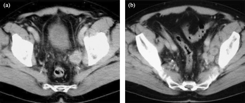 CT/MRI of nodal metastases in pelvic cancer | Cancer Imaging | Full Text