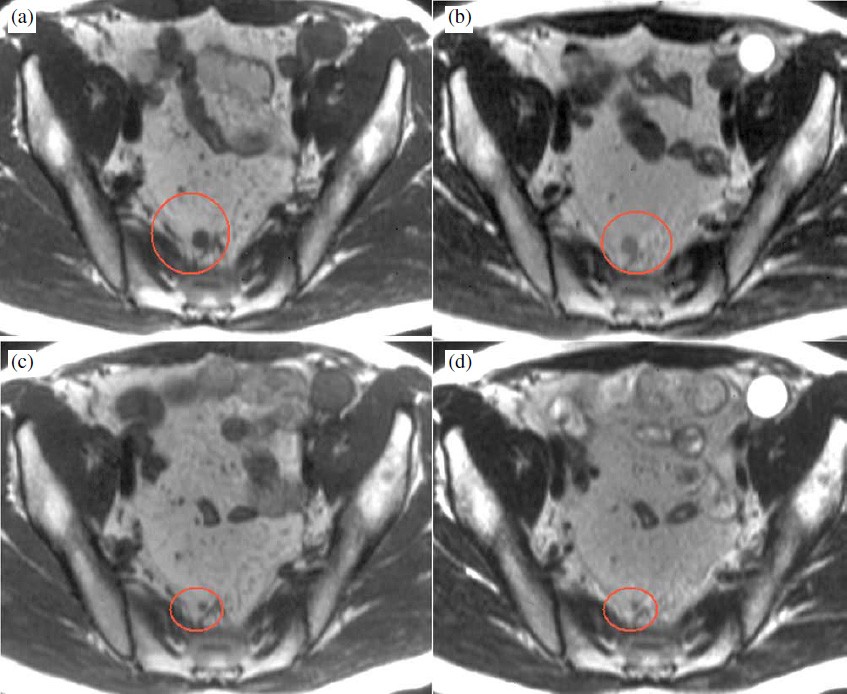CT/MRI of nodal metastases in pelvic cancer | Cancer Imaging | Full Text