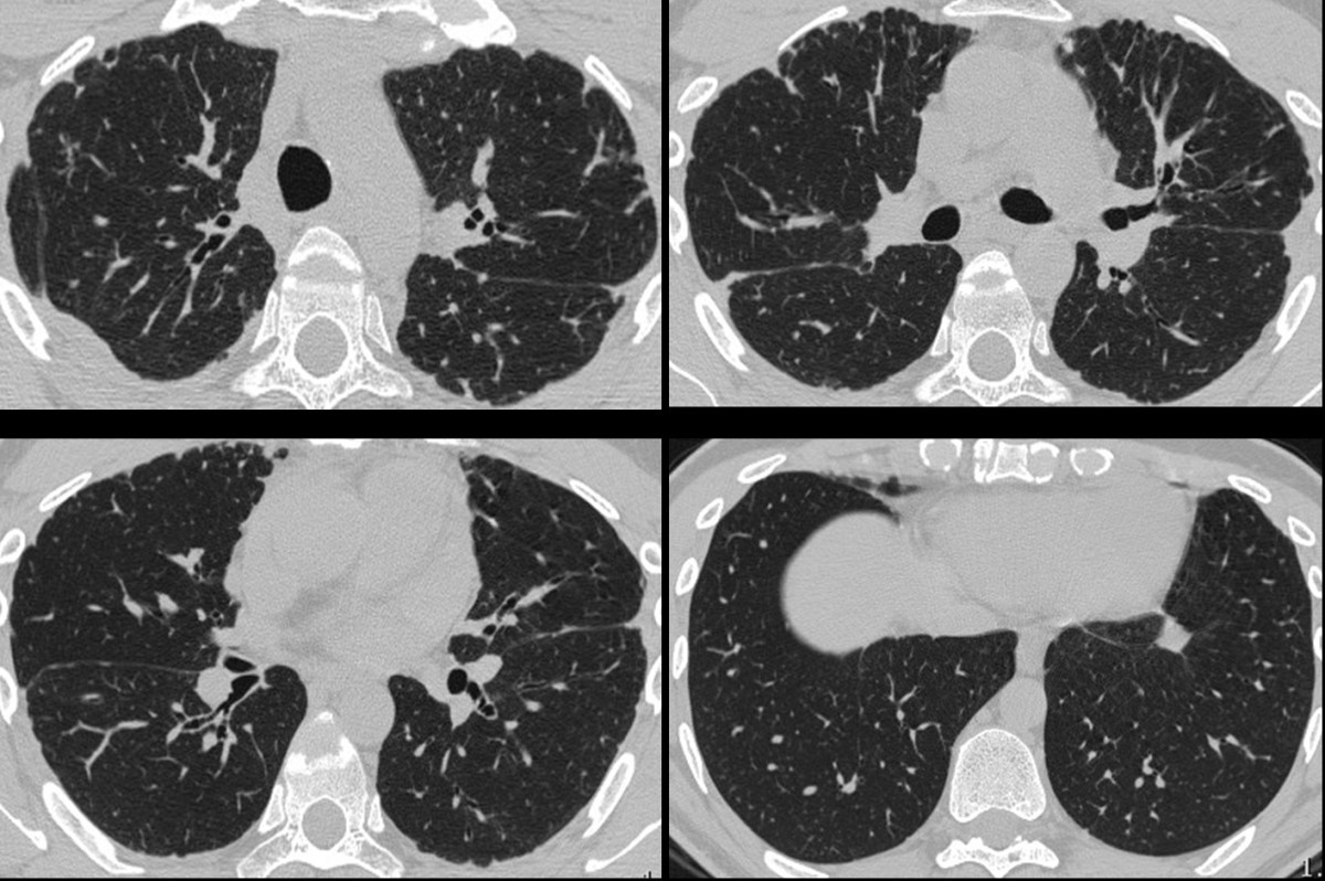 High Resolution CT And Histological Findings In Idiopathic ...