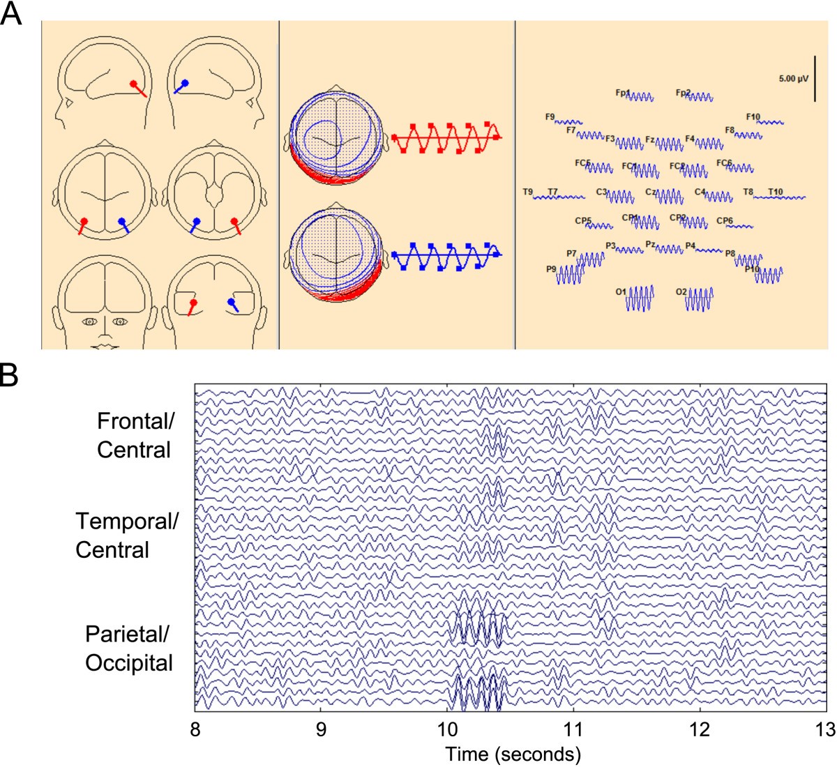Detecting alpha spindle events in EEG time series using adaptive