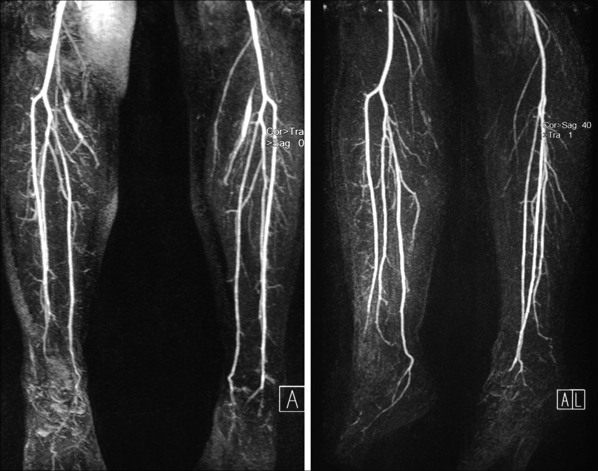 Treatment of thromboangiitis obliterans (Buerger's disease) with