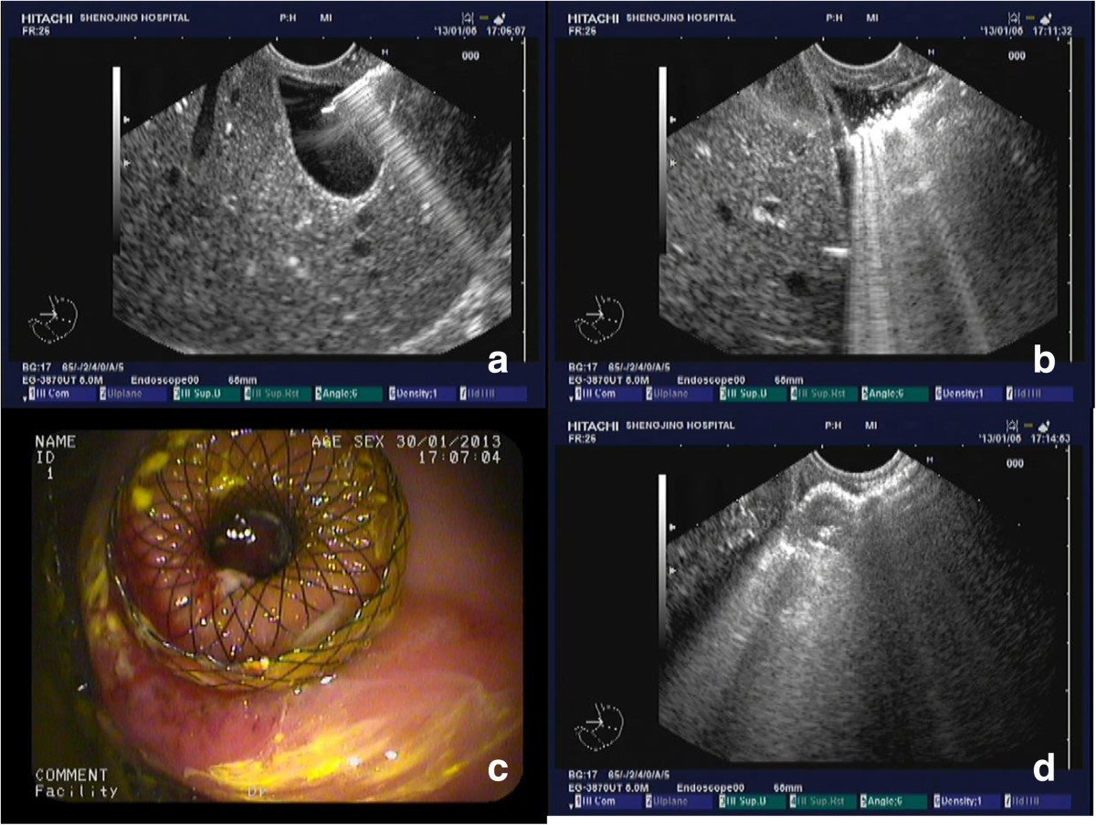 EUS assisted transmural cholecystogastrostomy fistula creation as a