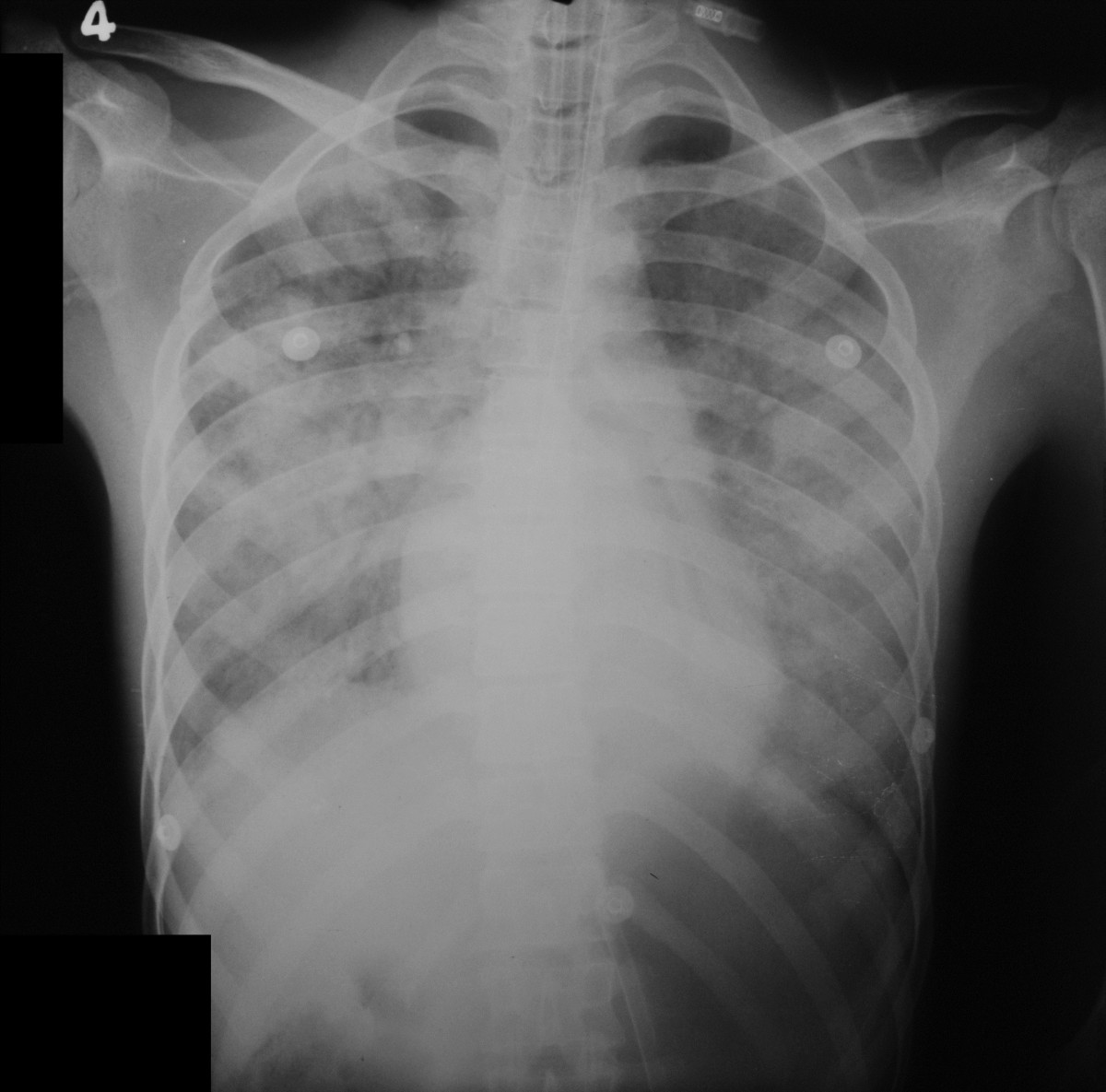 Pancreatitis and myocarditis followed by pulmonary hemorrhage, a rare ...