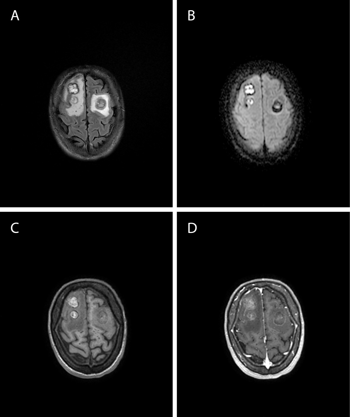 Brain localization of Kaposi’s in a patient treated by