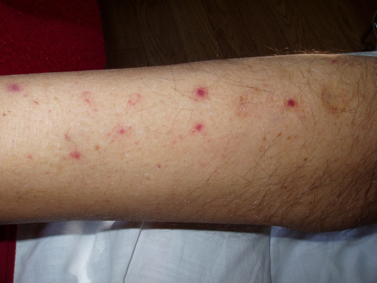 Outcome of acute East African trypanosomiasis in a Polish traveller